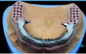 TRIMMER DENTURES ON IMPLANTS