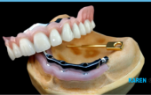TRIMMER DENTURES ON IMPLANTS