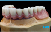 TRIMMER DENTURES ON IMPLANTS