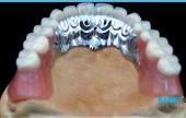 TRIMMER DENTURES ON IMPLANTS