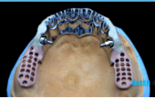 TRIMMER DENTURES ON IMPLANTS