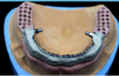 TRIMMER DENTURES ON IMPLANTS